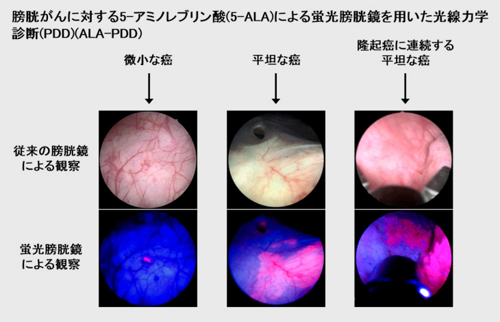 膀胱がんに対する5-アミノレブリン酸 (5-ALA) による蛍光膀胱鏡を用いた光線力学診断 (PDD) (ALA-PDD)