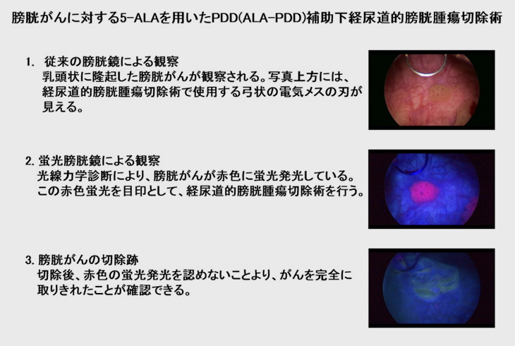 膀胱がんに対する5-ALAを用いたPDD（ALA-PDD）補助下経尿道的膀胱腫瘍切除術